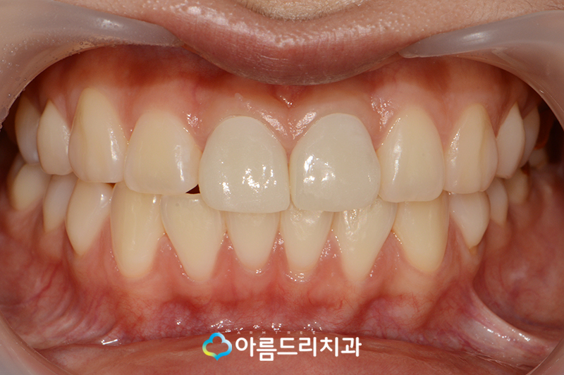 실활치미백 앞니 색깔 신경치료 치아변색 후기 관련 이미지 8