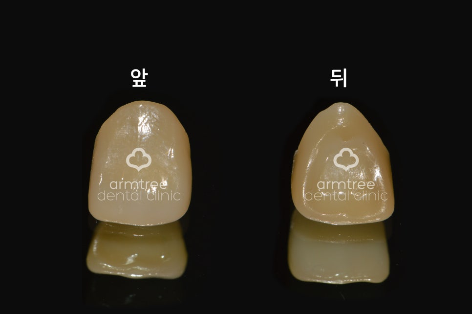 아름드리치과 이현정원장의 치료 이야기- 라미네이트란? 관련 이미지 3