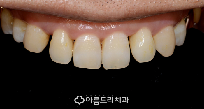 라미네이트교정 최소삭제 치아성형 후기 관련 이미지 7