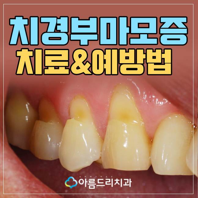 시린이 이시림치료 치경부마모증 관련 이미지 1