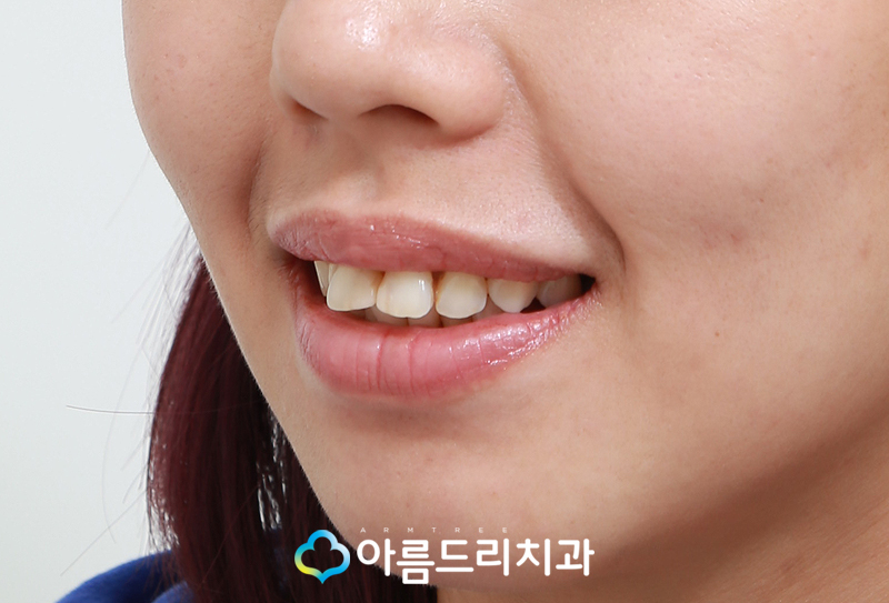 라미네이트연예인 이빨(치아) 최소삭제 이거다 관련 이미지 5