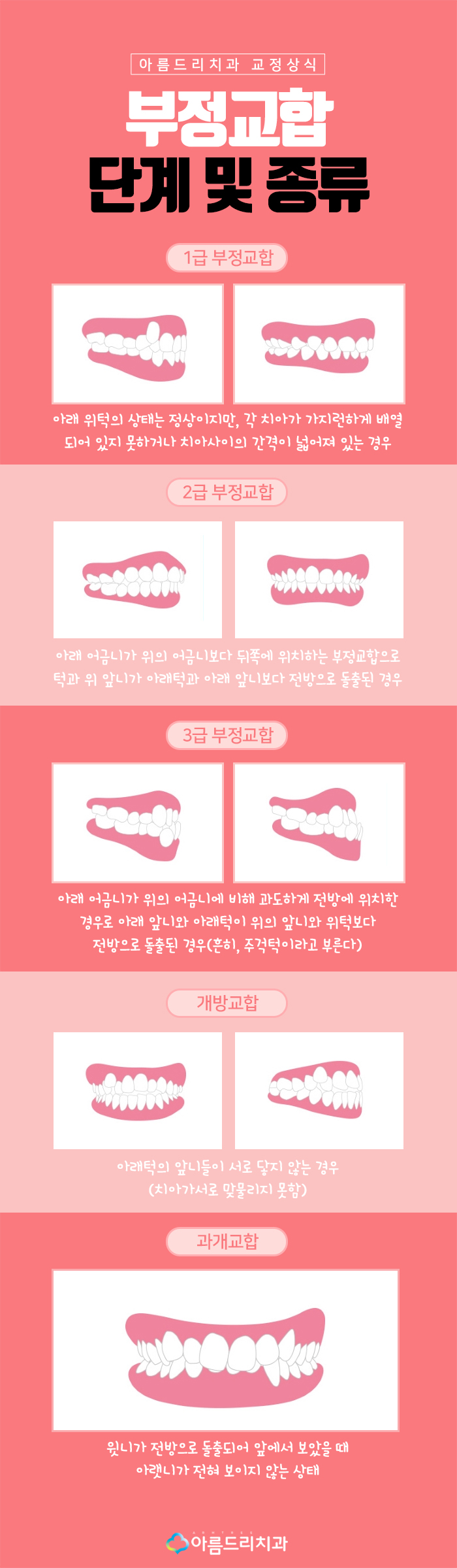 치아부정교합교정 원인과 예방법 관련 이미지 5
