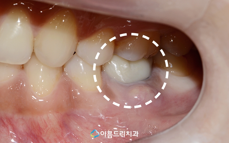잇몸고름주머니치료 염증제거 아름드리치과 관련 이미지 2