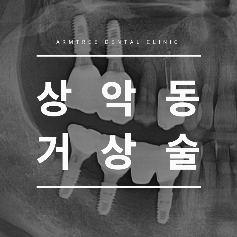 신논현치과 상악동거상술이 필요하다면 관련 이미지 1