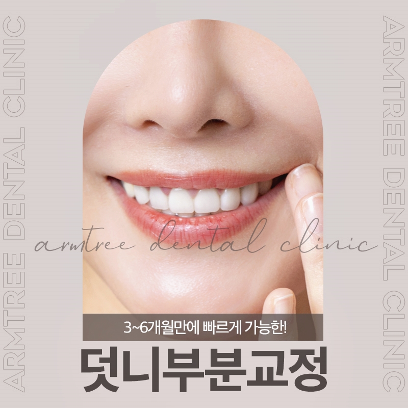 덧니부분교정후기 3~6개월만에 가능하다면 관련 이미지 1