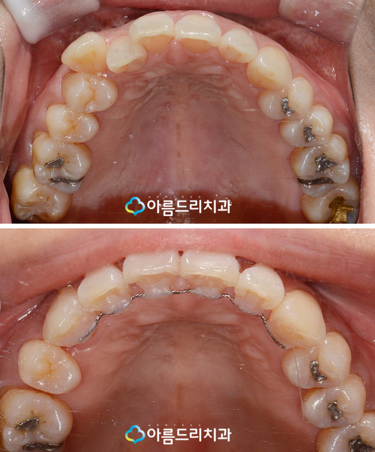 설측교정 후기앞니 단기간에 관련 이미지 8