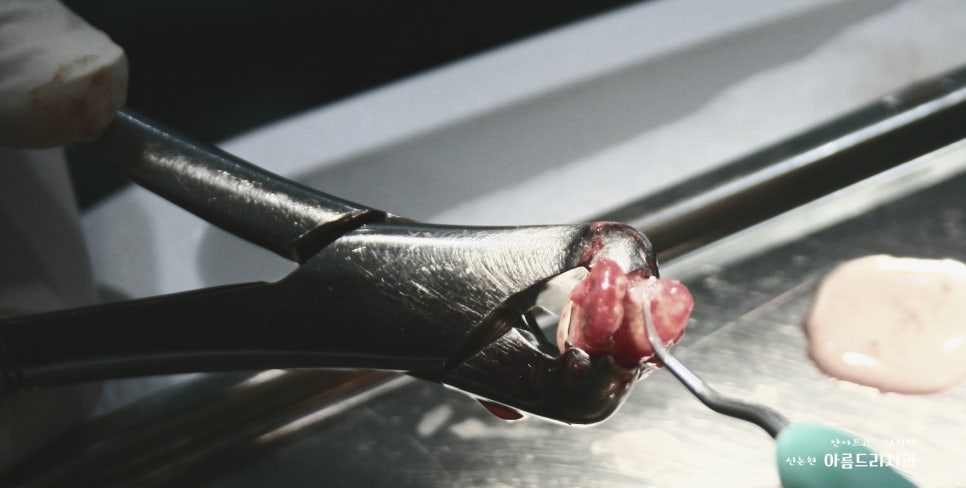 치아재식_임플란트 안 하고 치아 살릴 순 없나요?(신논현역 치과) 관련 이미지 6