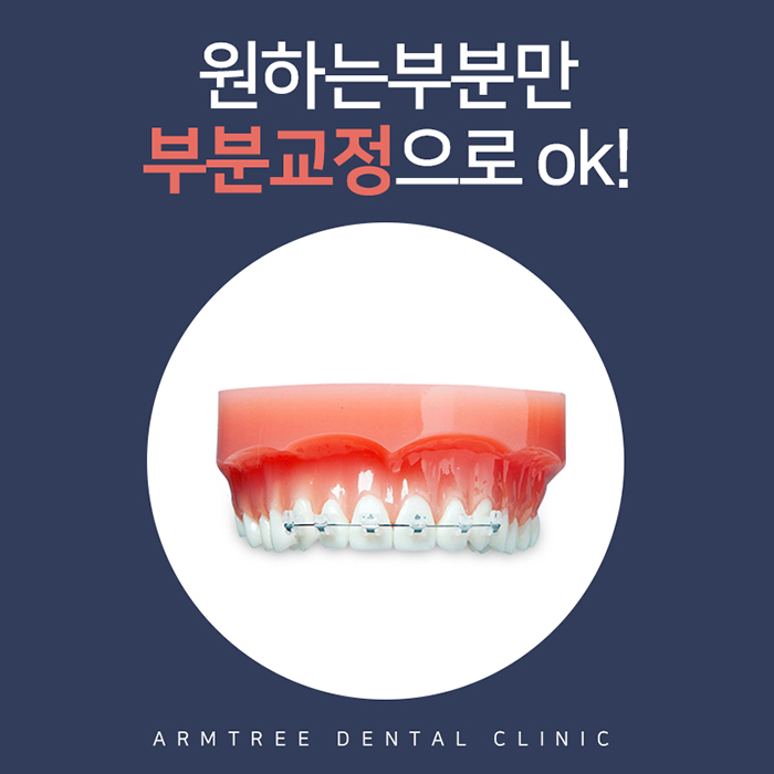 돌출앞니부분교정 제대로 알자 관련 이미지 2