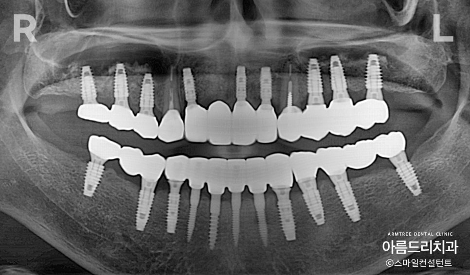 전체임플란트 전악임플란트 전후 아름드리치과 진료일기 관련 이미지 10