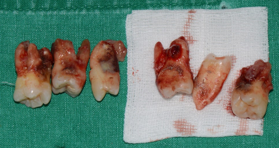 부분교정+임플란트(진료일기) 관련 이미지 3