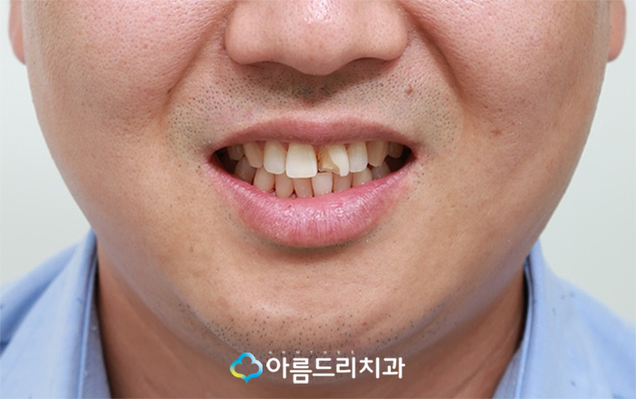 앞니깨짐 치료 최소삭제라미네이트 리얼후기 관련 이미지 3