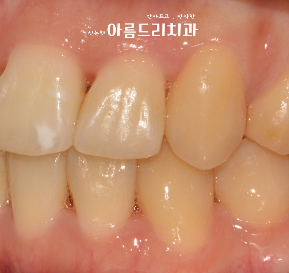 덧니 교정, 악궁 확장장치, 쁘띠 교정_신논현역 아름드리치과 관련 이미지 12
