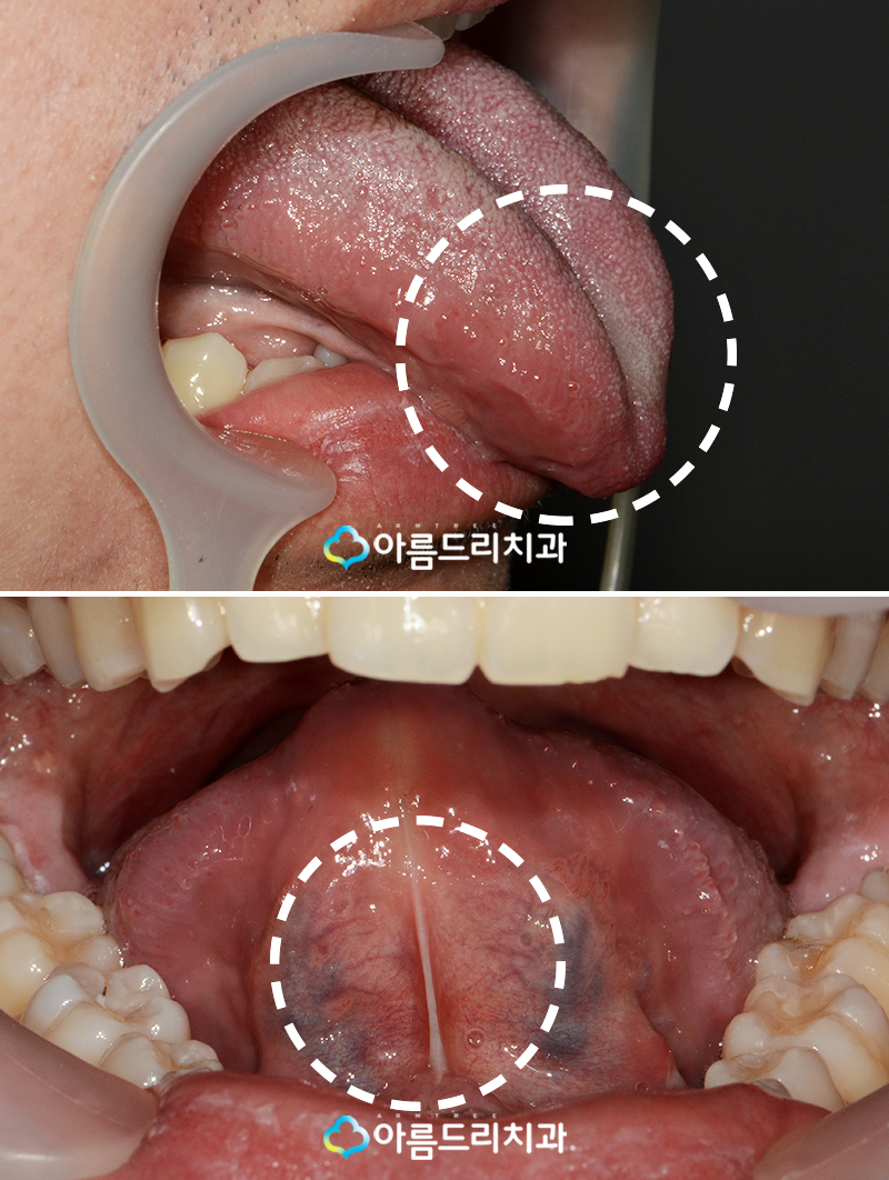 설소대단축증 - 단설소대증의 치료과정 관련 이미지 3