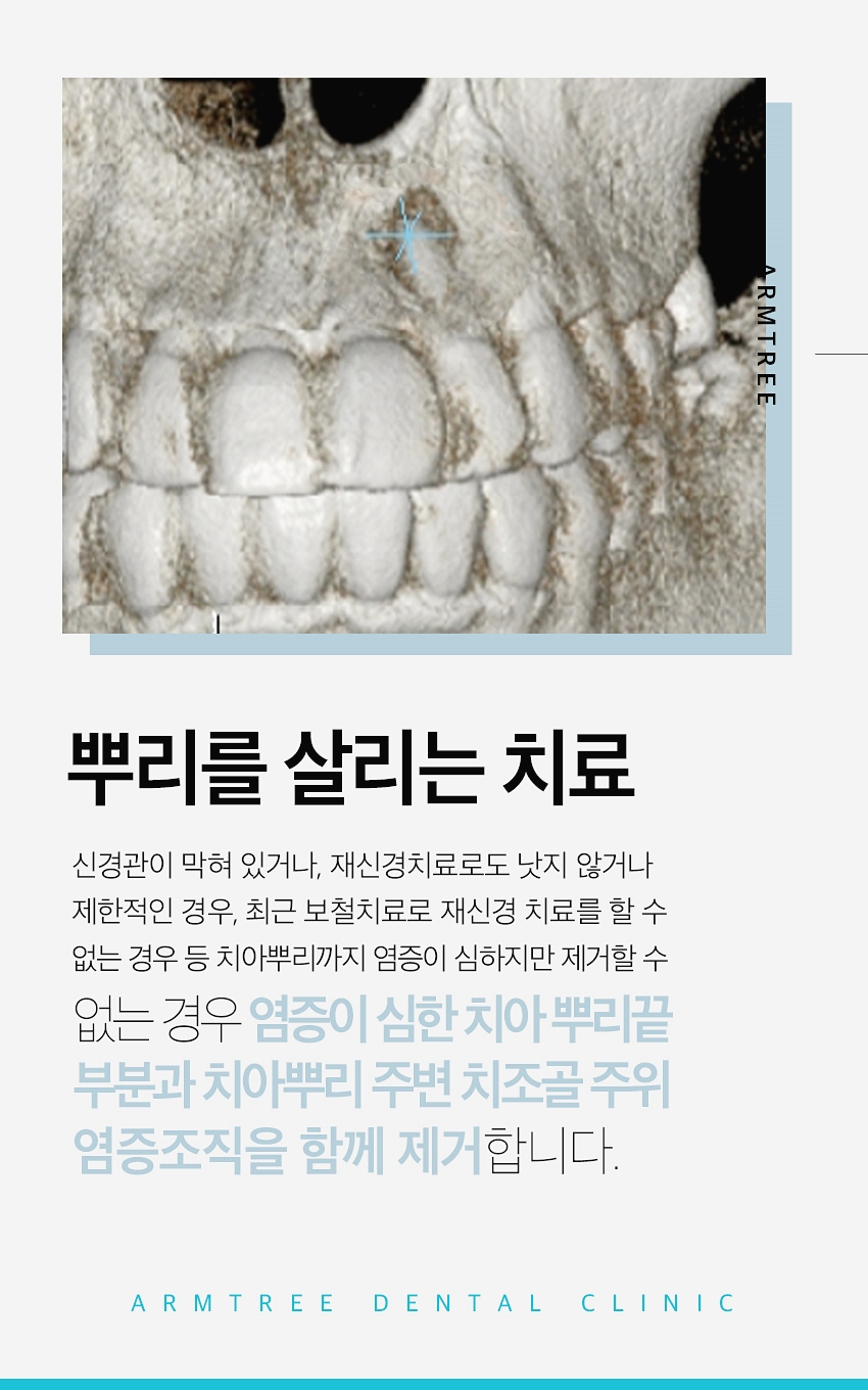 치근단절제술 염증 신뢰있는 후기 아름드리치과 관련 이미지 3