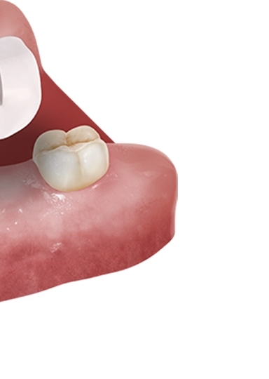 디지털임플란트 당일임플란트로 정확하고 안전하다면 관련 이미지 25