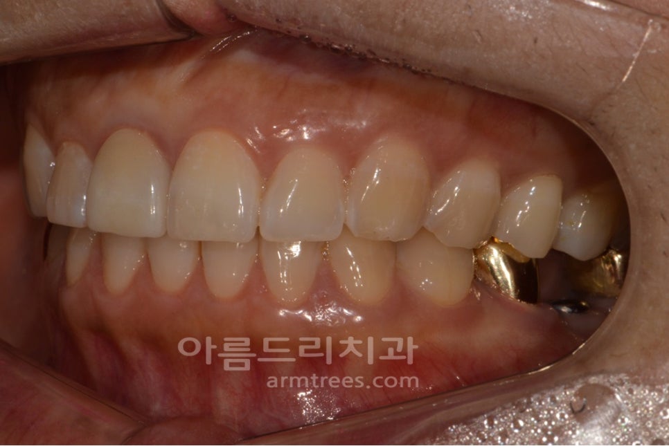 앞니 올세라믹 _재시술 (잇몸변색,메탈노출) 관련 이미지 8