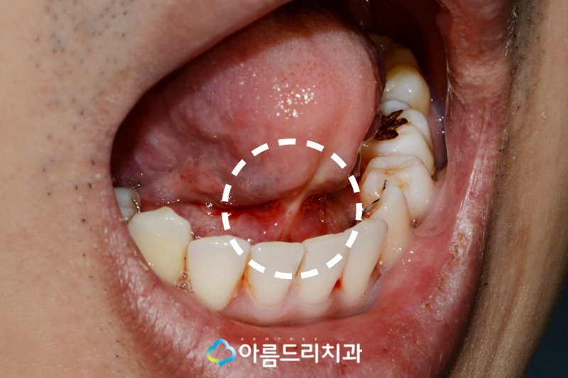 성인 설소대 수술 시술 완벽하게 관련 이미지 4
