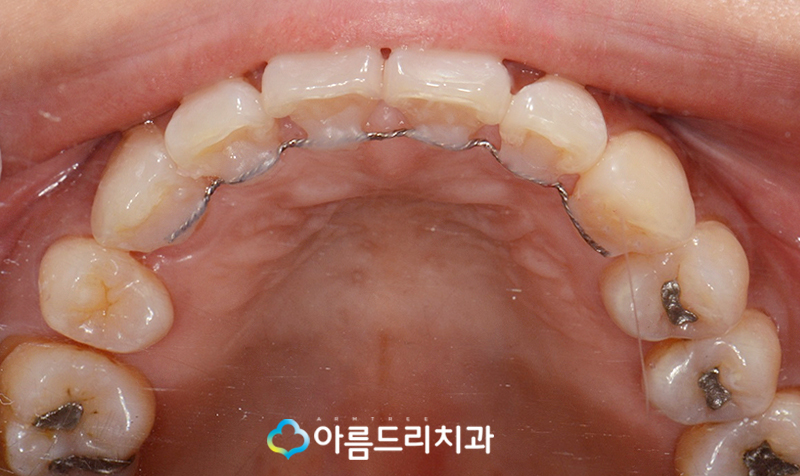 드라큘라이빨 송곳니교정 부분교정후기 관련 이미지 12