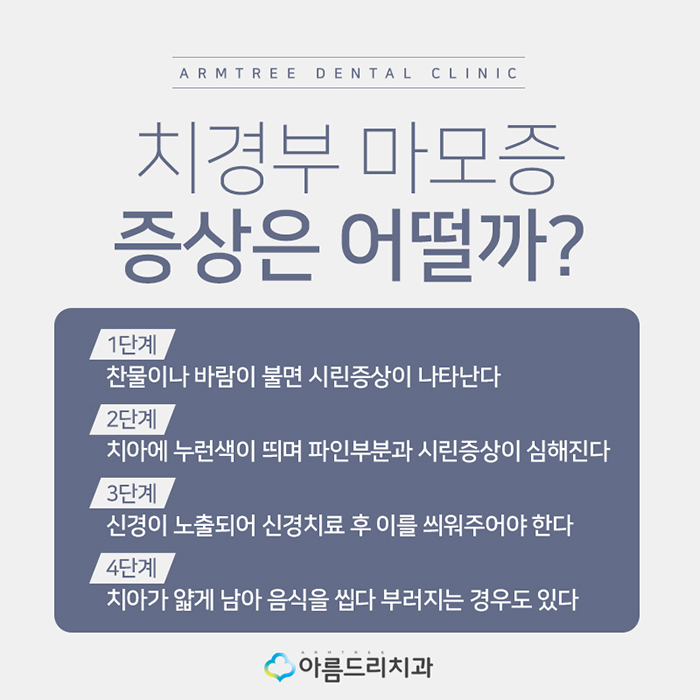 치경부마모증 잇몸파임 시린이 치료 관련 이미지 4