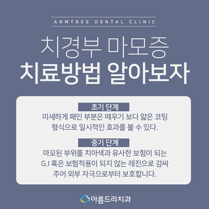 치경부마모증 잇몸파임 시린이 치료 관련 이미지 5
