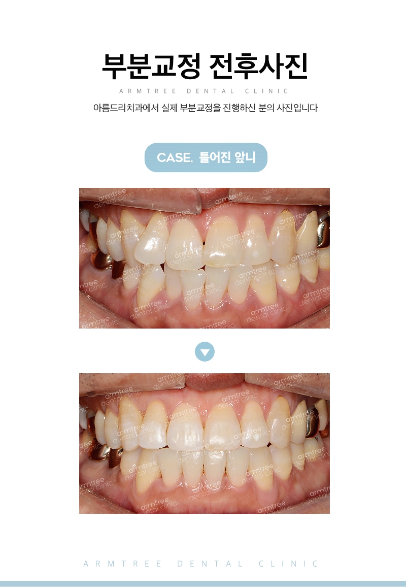 부분교정기간 신중하게 아름드리치과 관련 이미지 13