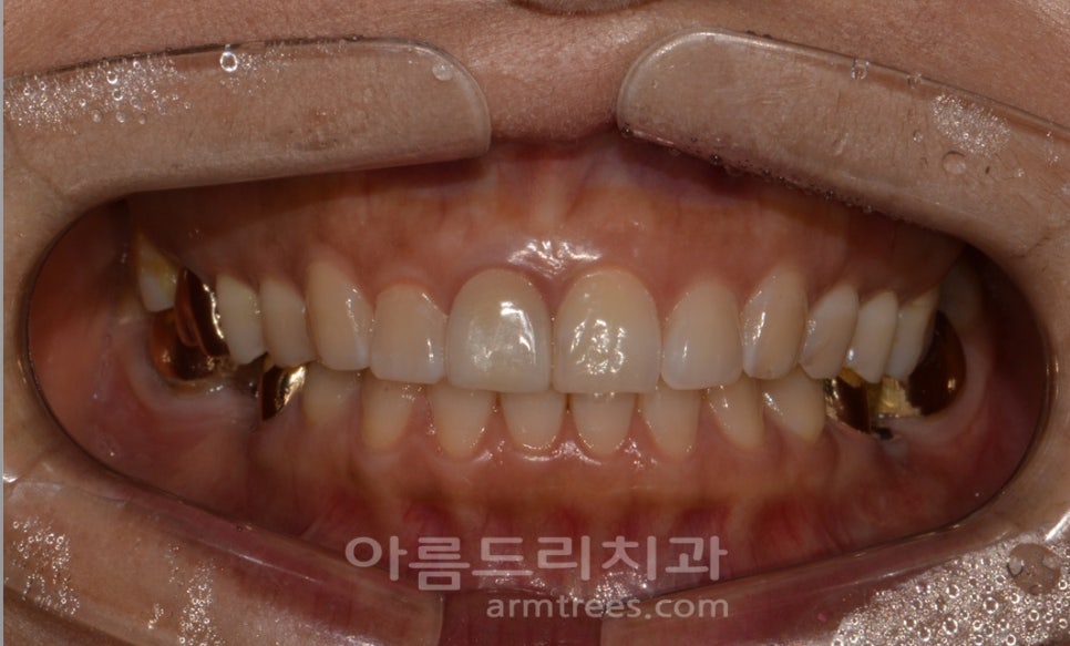 앞니 올세라믹 _재시술 (잇몸변색,메탈노출) 관련 이미지 7