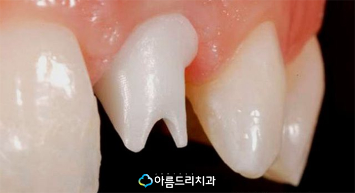 치아탈구(깨짐) 앞니임플란트 지르코니아어버트먼트 관련 이미지 8