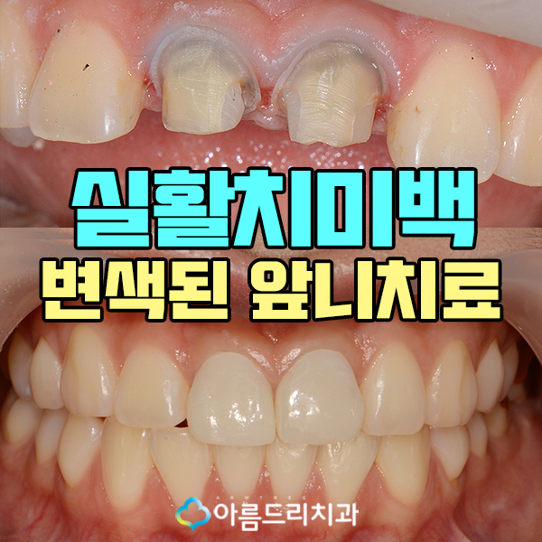 실활치미백 앞니 색깔 신경치료 치아변색 후기 관련 이미지 1