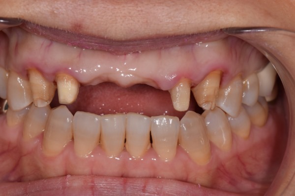 앞니 크라운 재치료 & 잇몸성형 _건강하게 . 예뻐지는 방법 관련 이미지 7