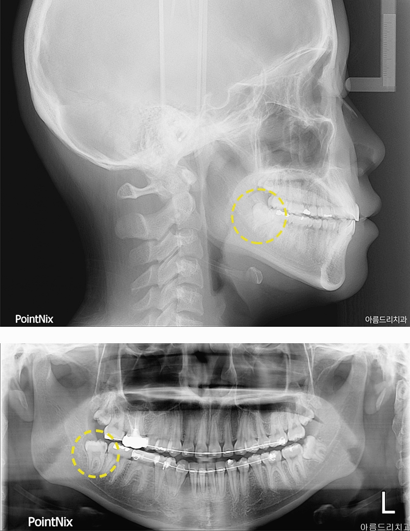 매복사랑니 발치후기 통증없는 아름드리치과 관련 이미지 2