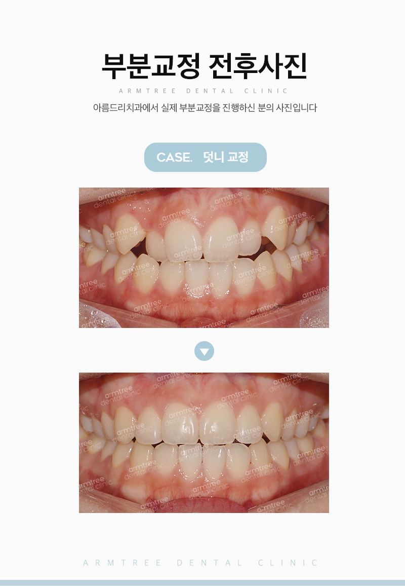 덧니부분교정 앞니송곳니는 아름드리치과 관련 이미지 11