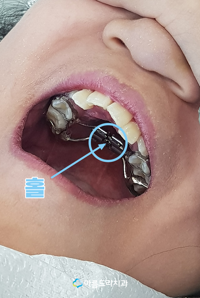 어린이 부정교합교정 RPE 악궁확장장치 관련 이미지 7