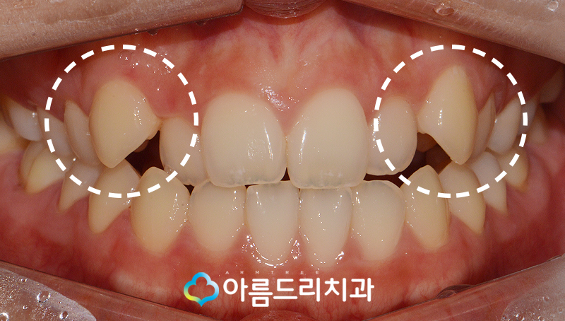덧니부분교정 앞니 이런후기만 관련 이미지 3