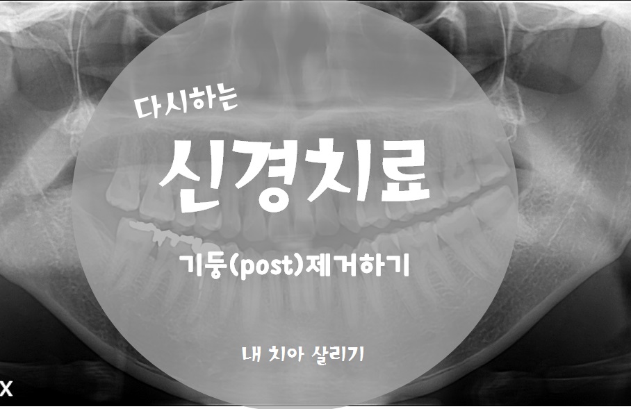 재신경치료_다시하는 신경치료 _기둥(post) 제거하기 관련 이미지 1