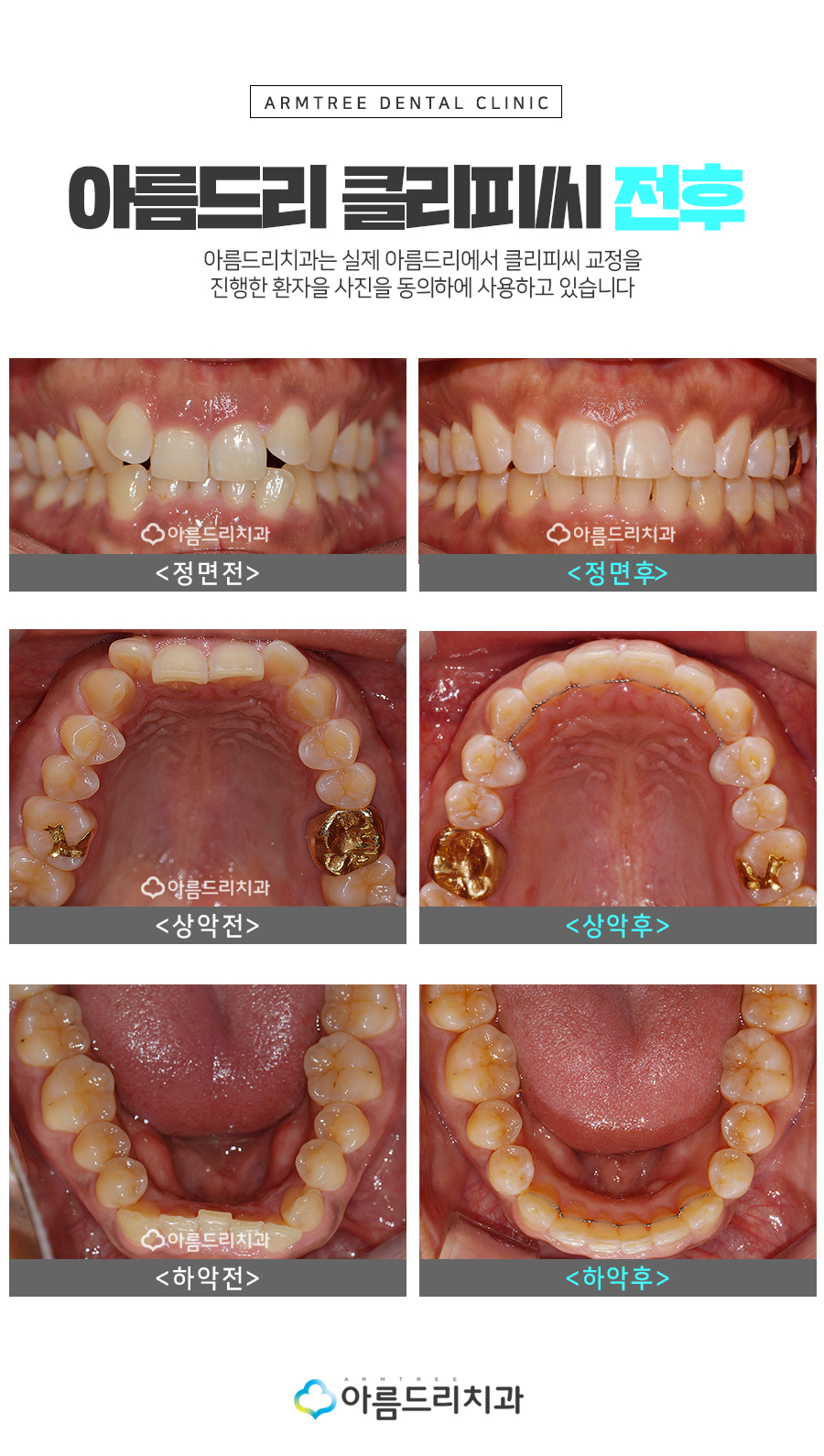 클리피시교정 후기와 기간 궁금해? 관련 이미지 7