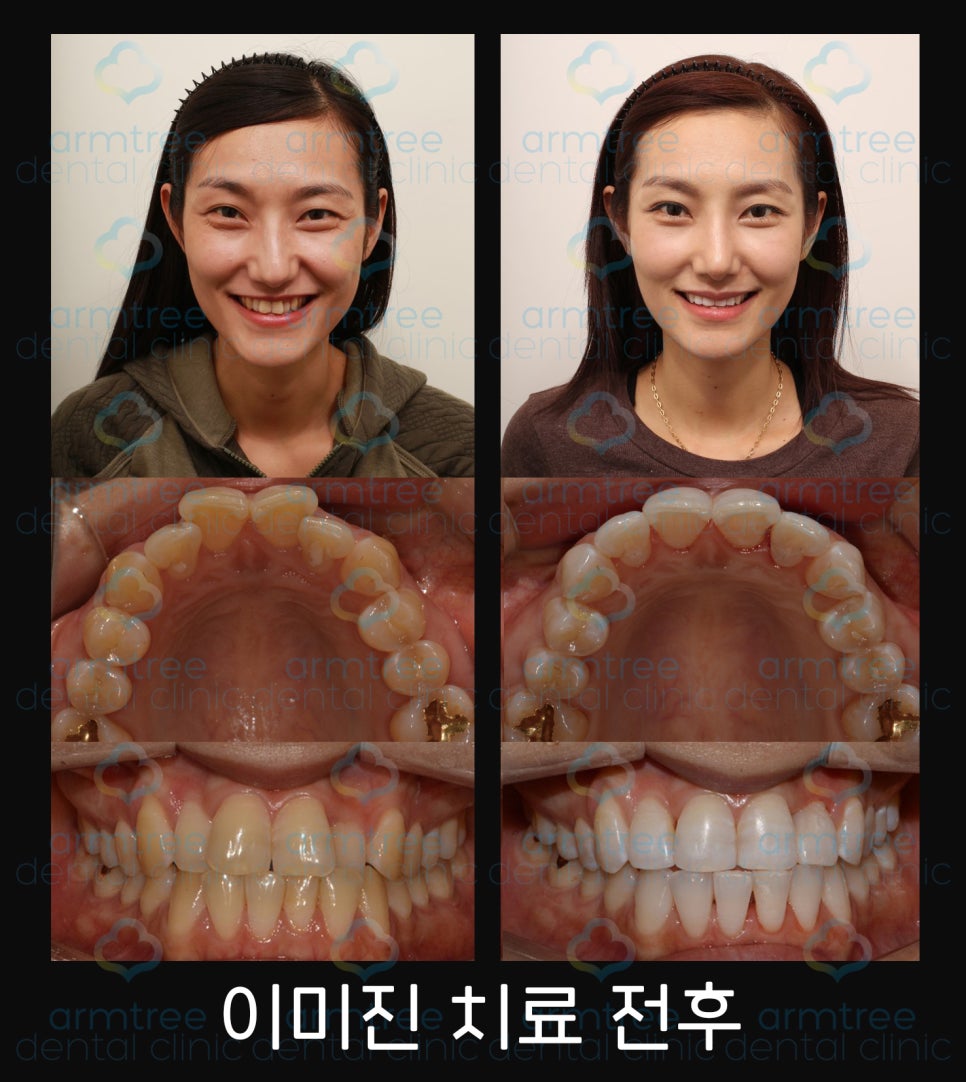 이현정 원장의 아름다운 당신 시즌 1 (7회 이미진 도전자) 급속교정, 치아미백, 화이트랩스 관련 이미지 3