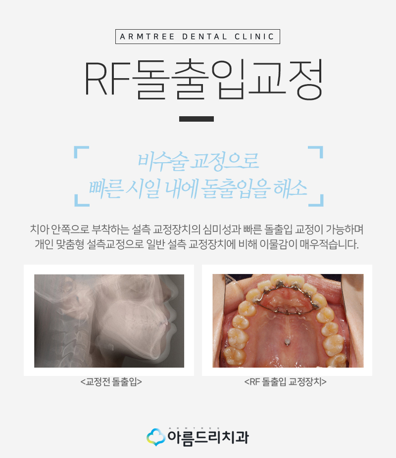 돌출입교정후기 급속으로 입툭튀 안녕 관련 이미지 5