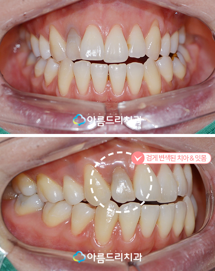 실활치 미백으로 앞니변색 해결후기 관련 이미지 3