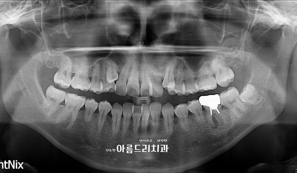 덧니 교정, 악궁 확장장치, 쁘띠 교정_신논현역 아름드리치과 관련 이미지 3