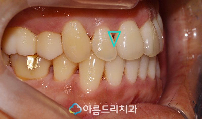 앞니 블랙트라이앵글 치아 이성형으로 해결 관련 이미지 5