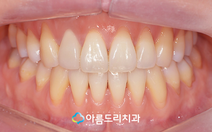 실활치 미백으로 앞니변색 해결후기 관련 이미지 7