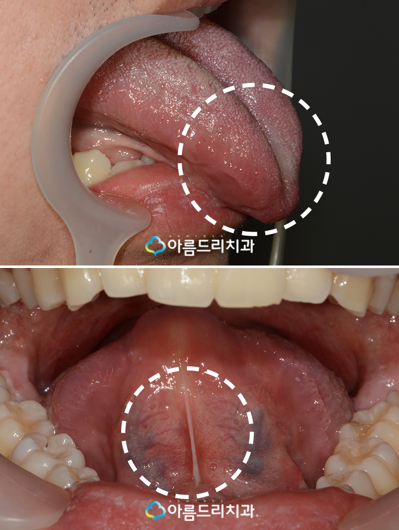 설소대수술 - 실제후기로 보는 확연한 차이 관련 이미지 3