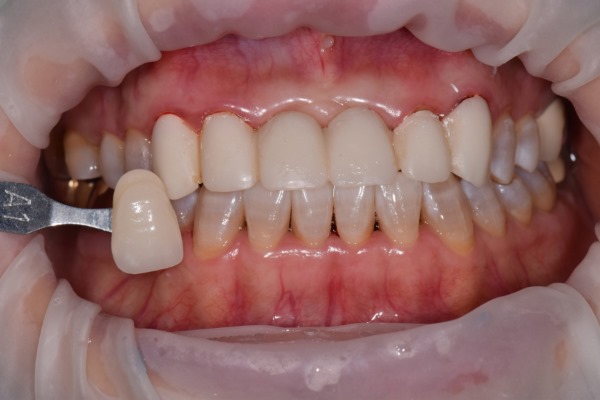 앞니 크라운 재치료 & 잇몸성형 _건강하게 . 예뻐지는 방법 관련 이미지 8