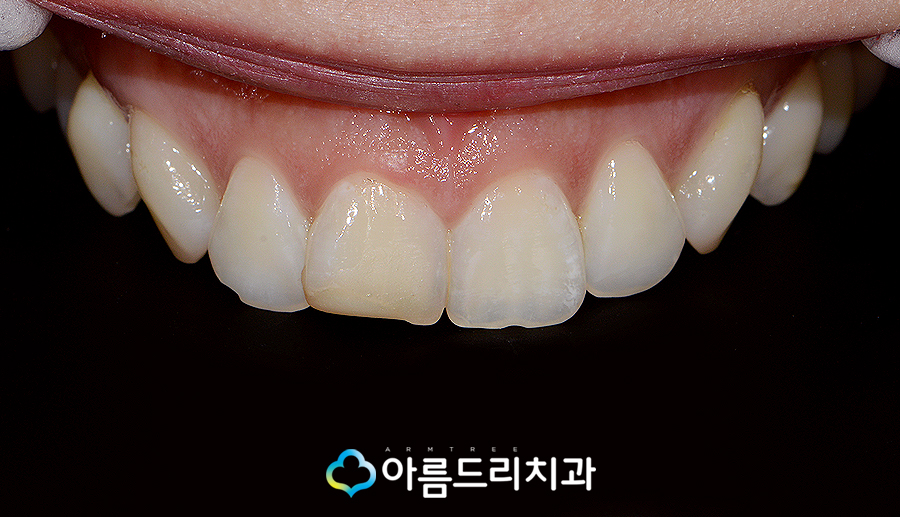 치아라미네이트 삭제량이 초중요 관련 이미지 7