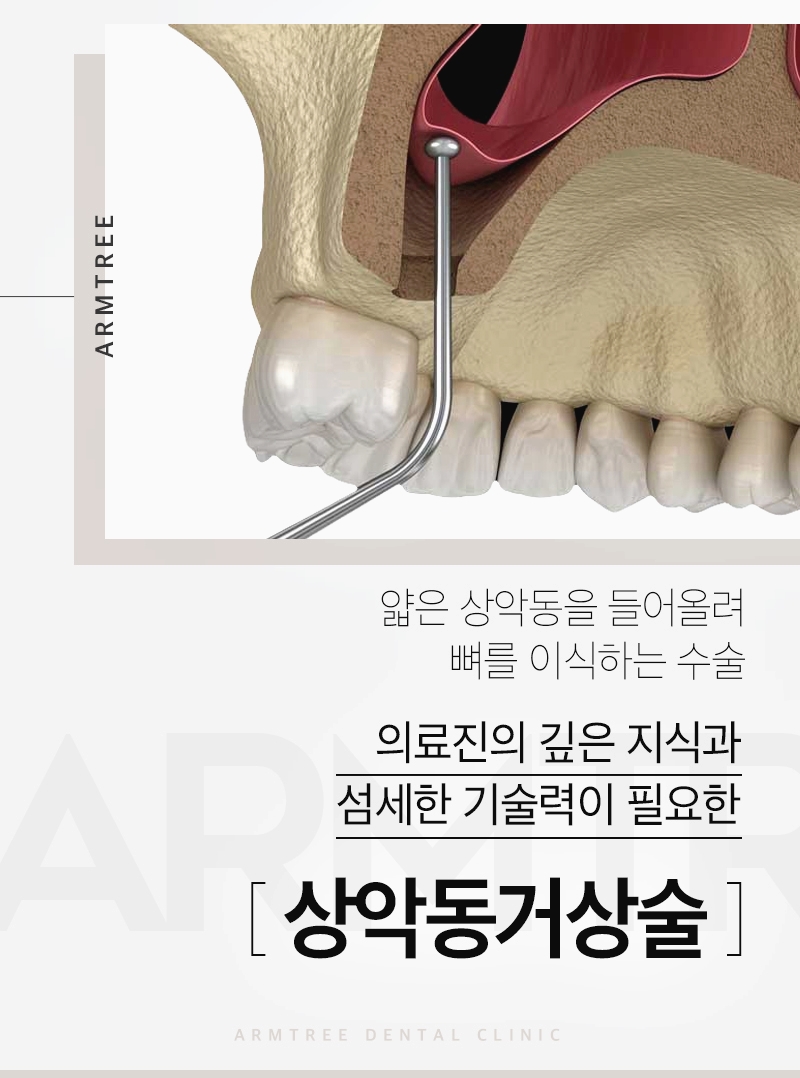 신논현역 상악동거상술 임플란트 아름드리치과는 관련 이미지 2