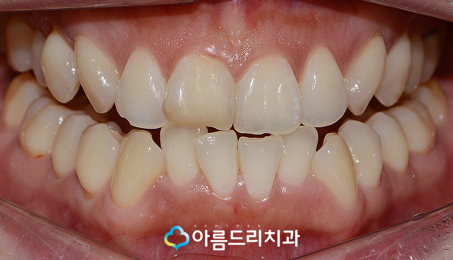 치아라미네이트 삭제량이 초중요 관련 이미지 4