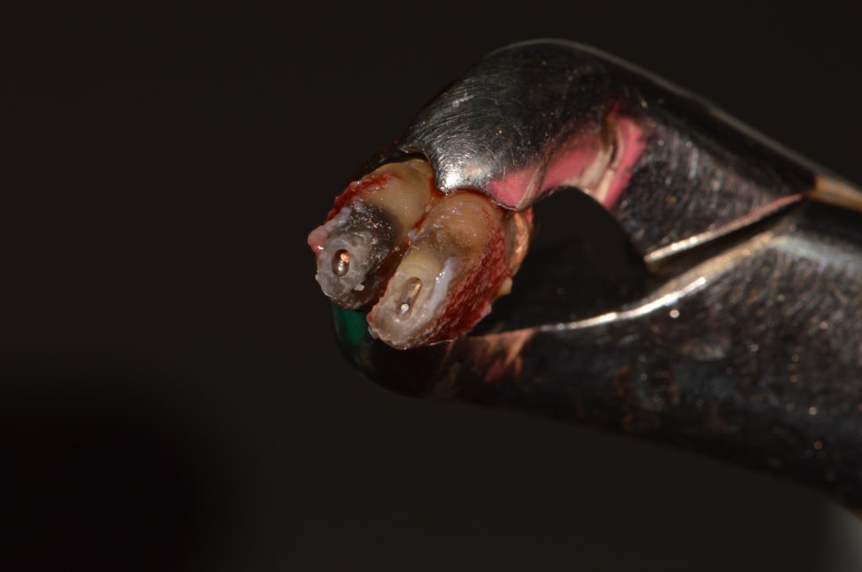 [신논현 치과] 임플란트 대신 치아재식(아름드리치과) 관련 이미지 8