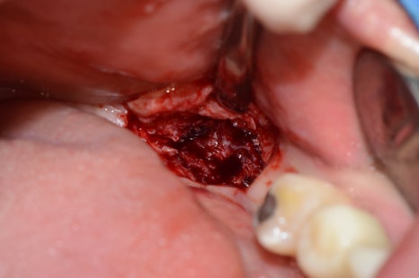 부분교정+임플란트(진료일기) 관련 이미지 6
