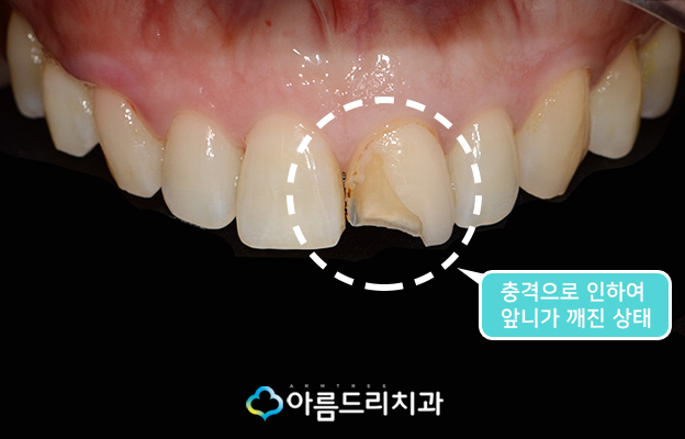앞니깨짐 치료후기 해결책 관련 이미지 4