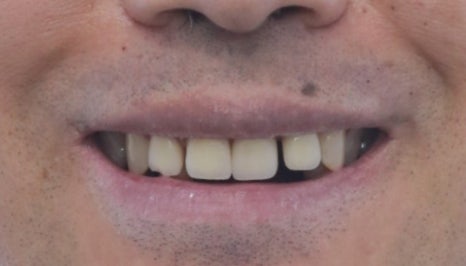 부분교정+임플란트(진료일기) 관련 이미지 9